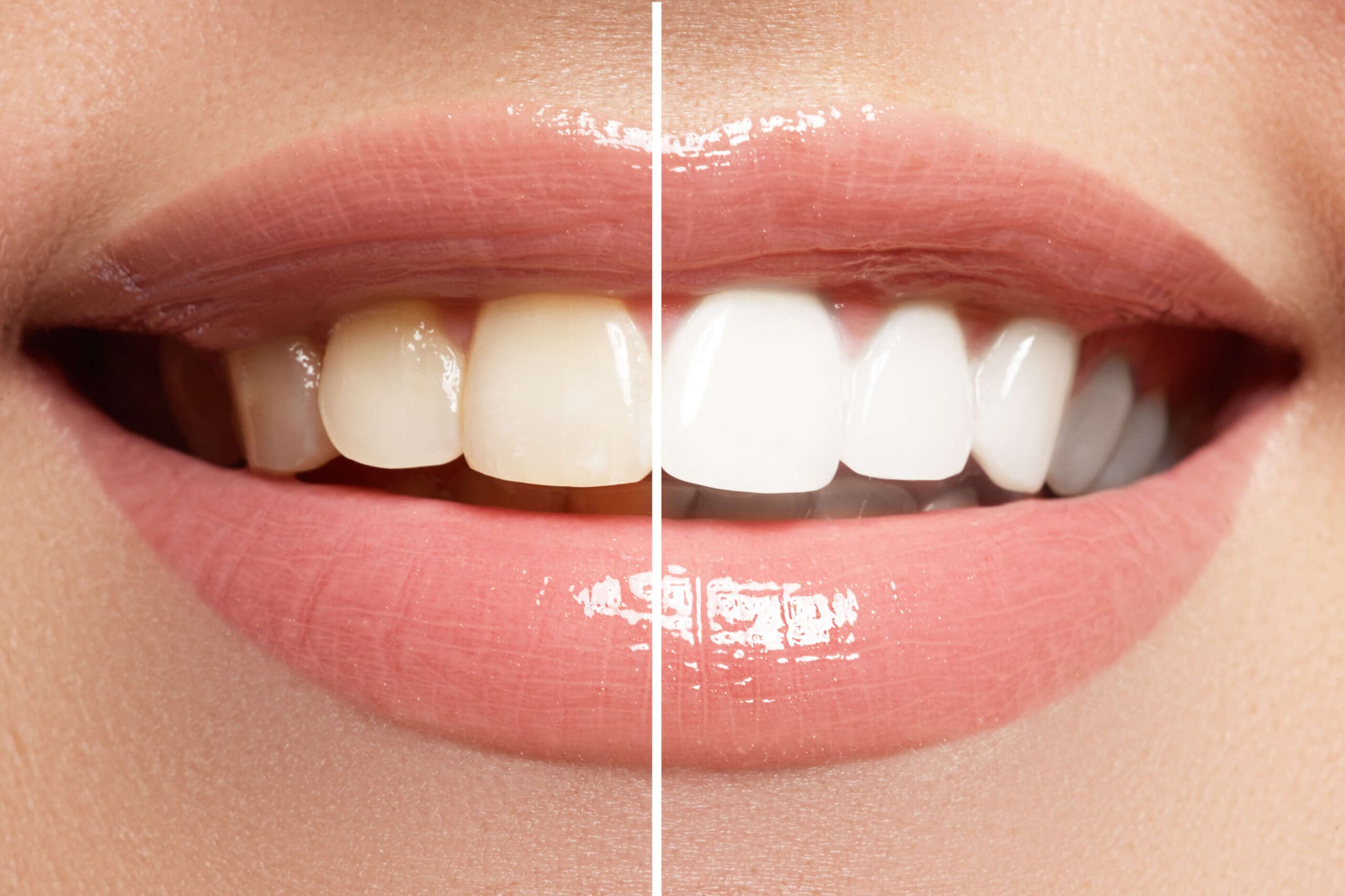 before and after teeth whitening smile